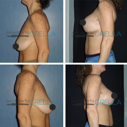 mastopessi-lifting-4